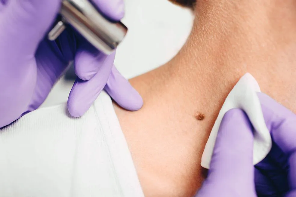 skin tag removal
