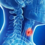 Oral Fibroma visual display