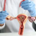 Tubal Ligation reversal