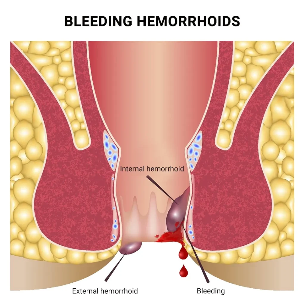 Thrombosed Hemorrhoid