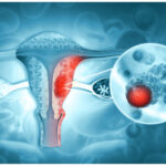 How Modern Medicine Is Changing the Future of Cervical and Anal Cancer Care