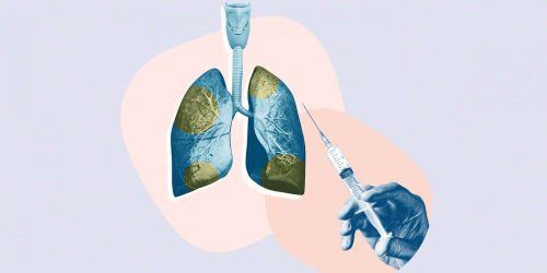 Beyond Antibiotics: Why Vaccines Are Key in Fighting Pneumonia