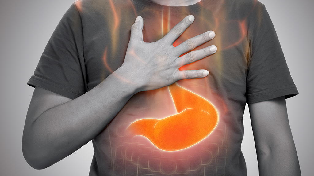 Can Acid Reflux Cause Chronic Cough and Throat Irritation?